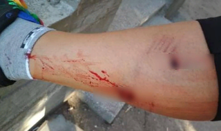 В Кисловодске девушка пострадала от укуса бездомной собаки