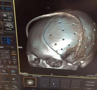 В Ставрополе выполнили операцию по восстановлению черепа с применением 3D-печати