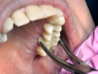 На Ставрополье стоматолог-мошенник лишил женщину зубов